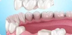Dental-Bridges-1
