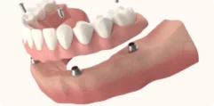 Implant-supported-dentures-1