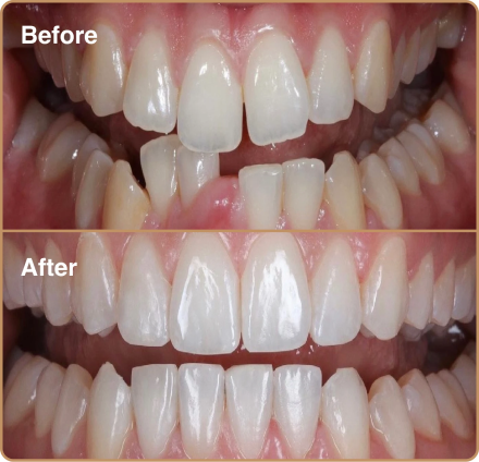 Invisalign before and after for crooked bottom teeth