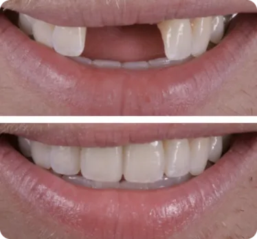dental-implants-before-after-374x348-1