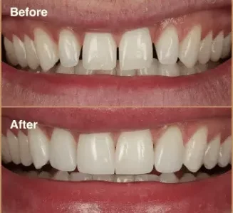 Invisalign-two-1-1