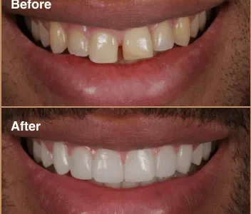 composite-before-after-5