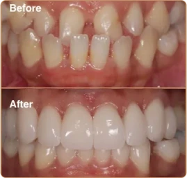 Porcelain Veneers Manchester