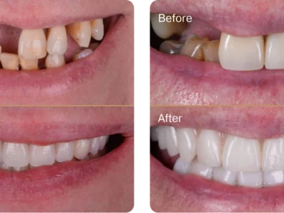 implant-vs-dentures