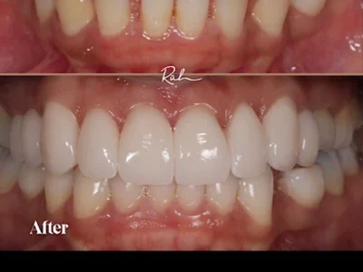 invisalign-porcelain