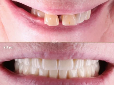dental-implants