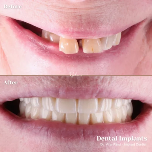 dental-implants dental-implants