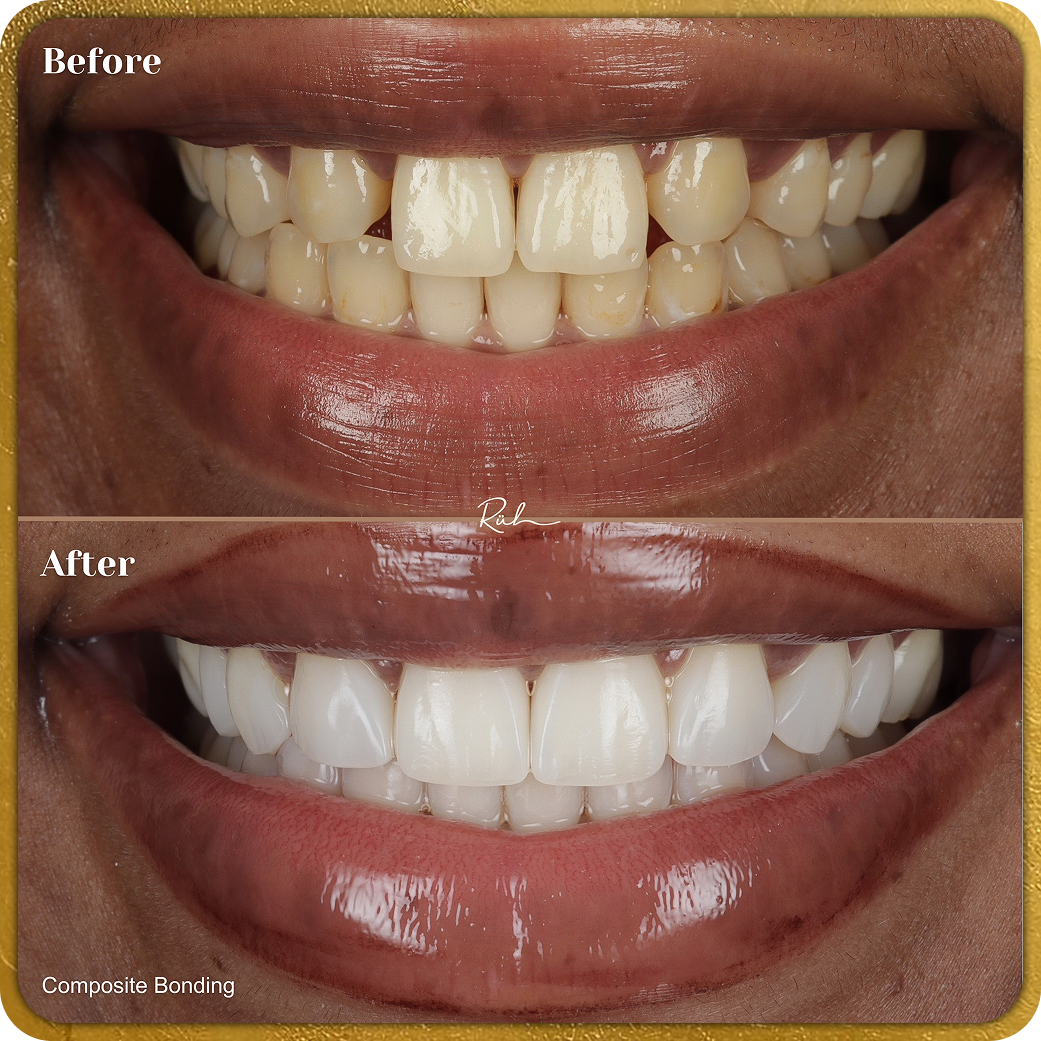 Composite Bonding B&A Gold Rim