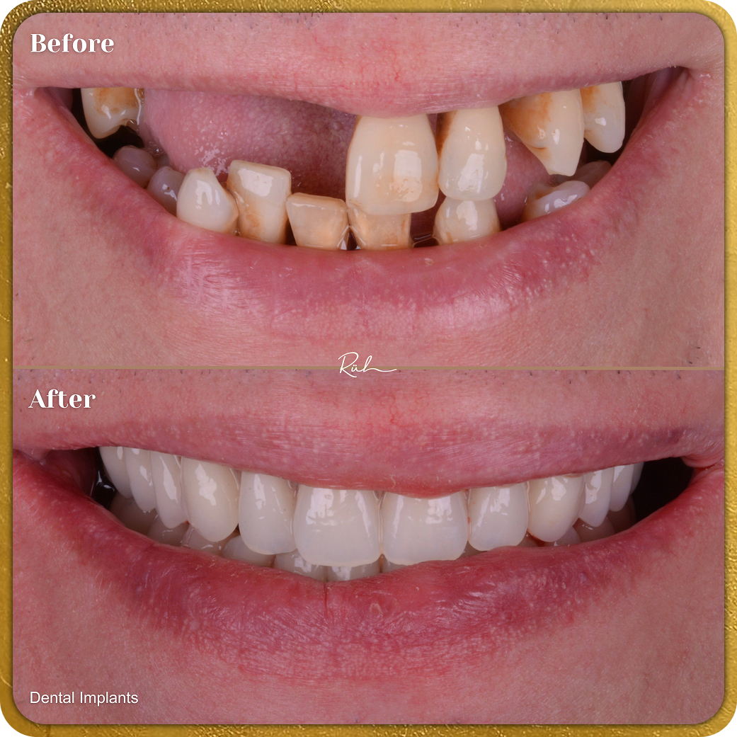 Implants B&A Gold Rim