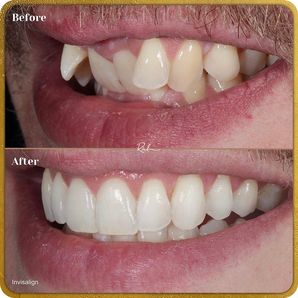 Invisalign B&A Gold Rim