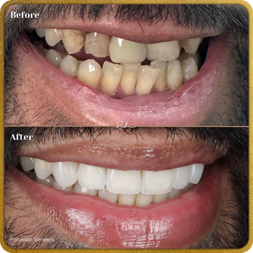 Porcelain Veneers